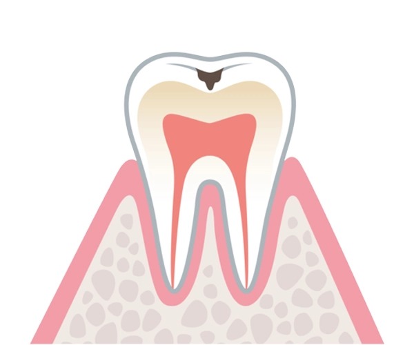 むし歯の進行