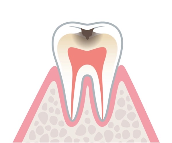 むし歯の進行