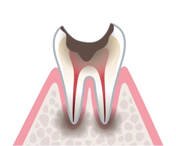 むし歯の進行