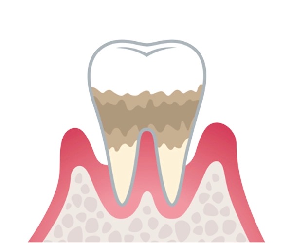 歯周病の進行