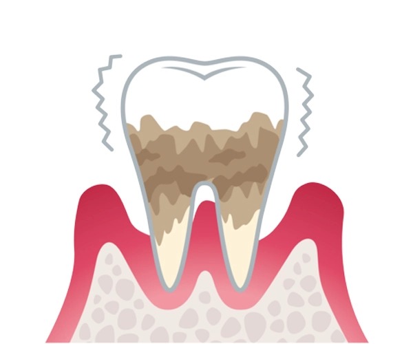 歯周病の進行
